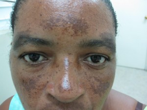 melasma